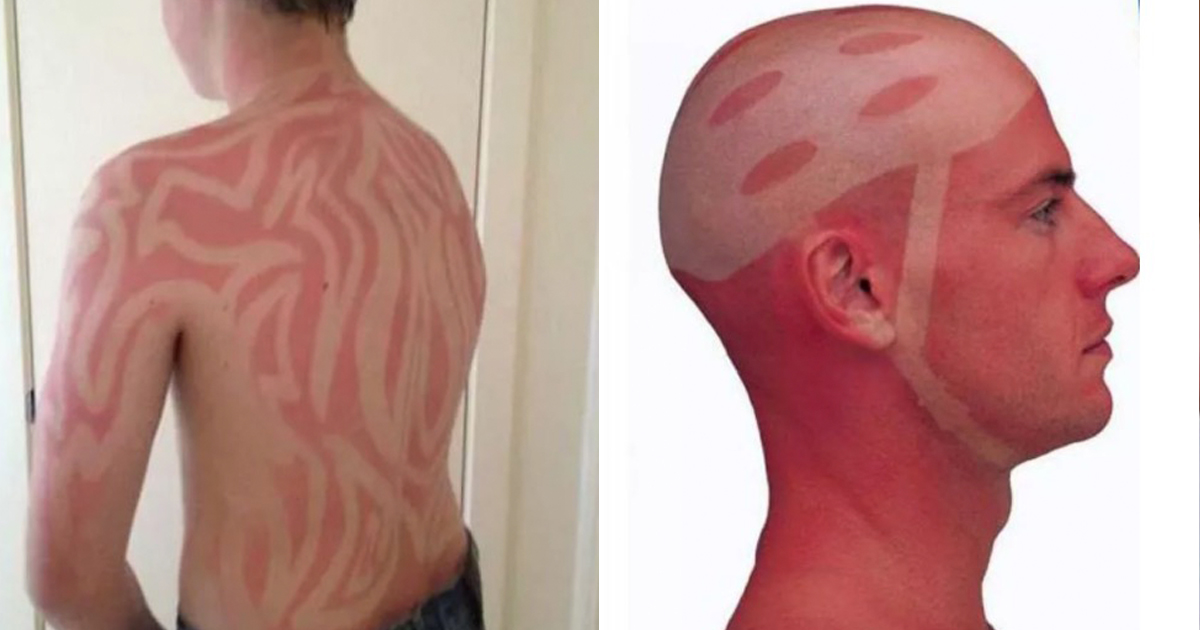 15 Sunburns That Will Pain You To See