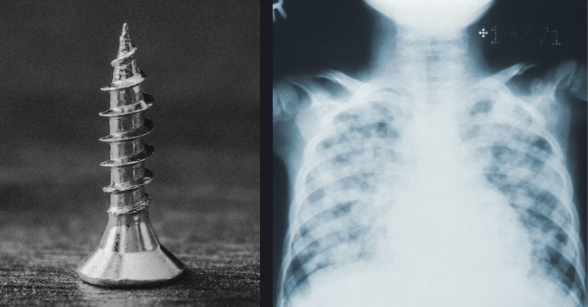 A Woman Accidentally Inhaled a Screw and Surgeons Had to Remove It From
